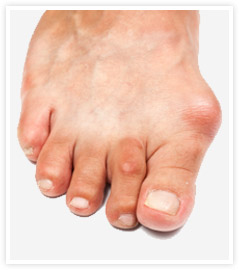 gout on the foot